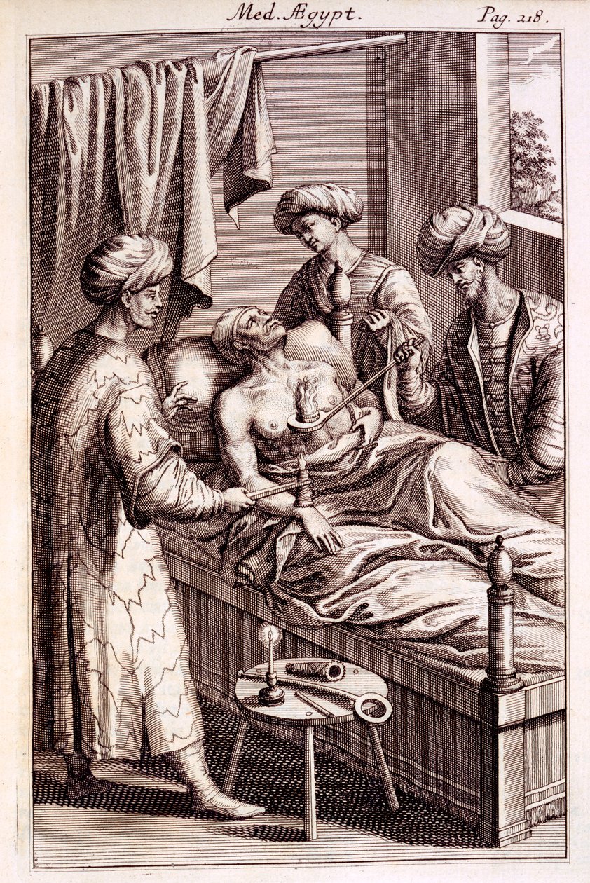 Illustration der Moxibustion aus Medicina Aegyptorum von Prospero Alpinus, 1745 von American School