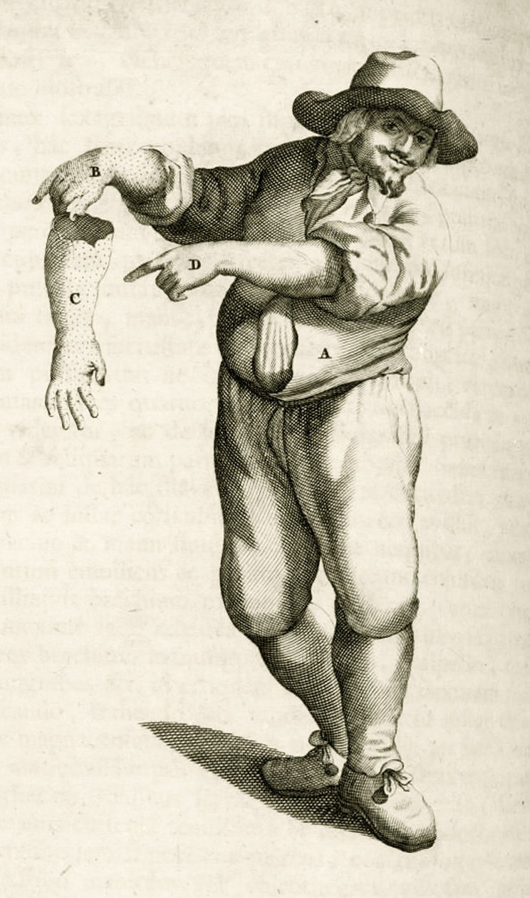 Entfernung abgestorbener Haut mit Pusteln, aus Exercitationes Practicae circa Medendi Methodum von Frederik Dekkers, 1694 von Dutch School
