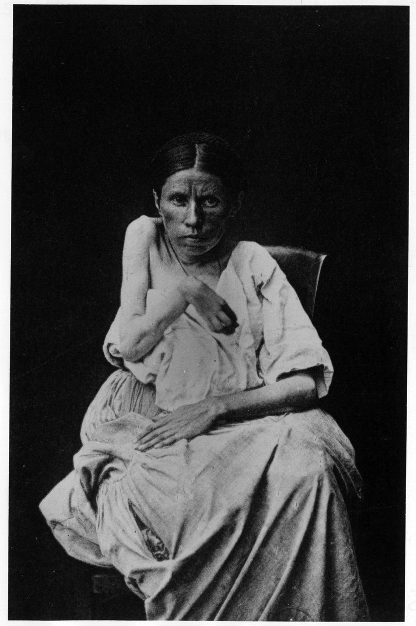 Fotografie eines Patienten mit hemiplegischer Epilepsie, in „photographische Ikonographie der Salpêtrière“, Bourneville und P. Regnard, Paris von French Photographer