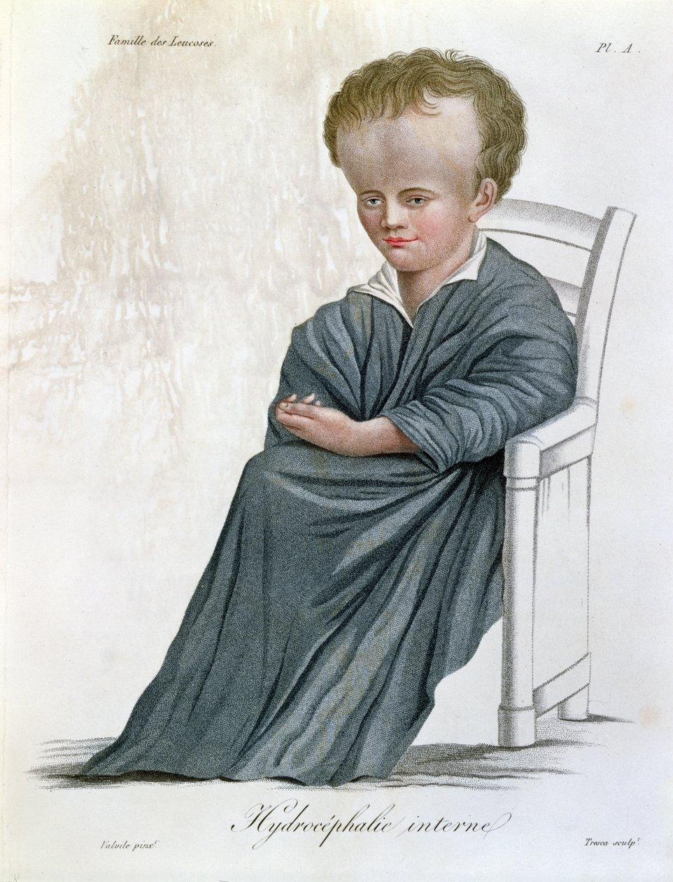 Interner Hydrozephalus, aus Nosologie Naturelle von Baron Jean Louis Alibert (1768-1837) graviert von Tresca, 1817 von French School