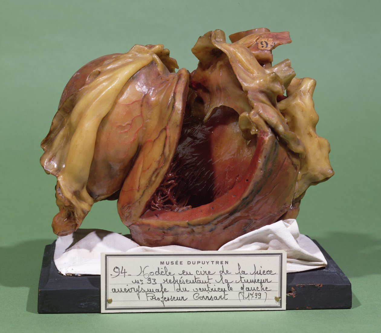 Modell eines Tumors des linken Ventrikels, 1799 von French School
