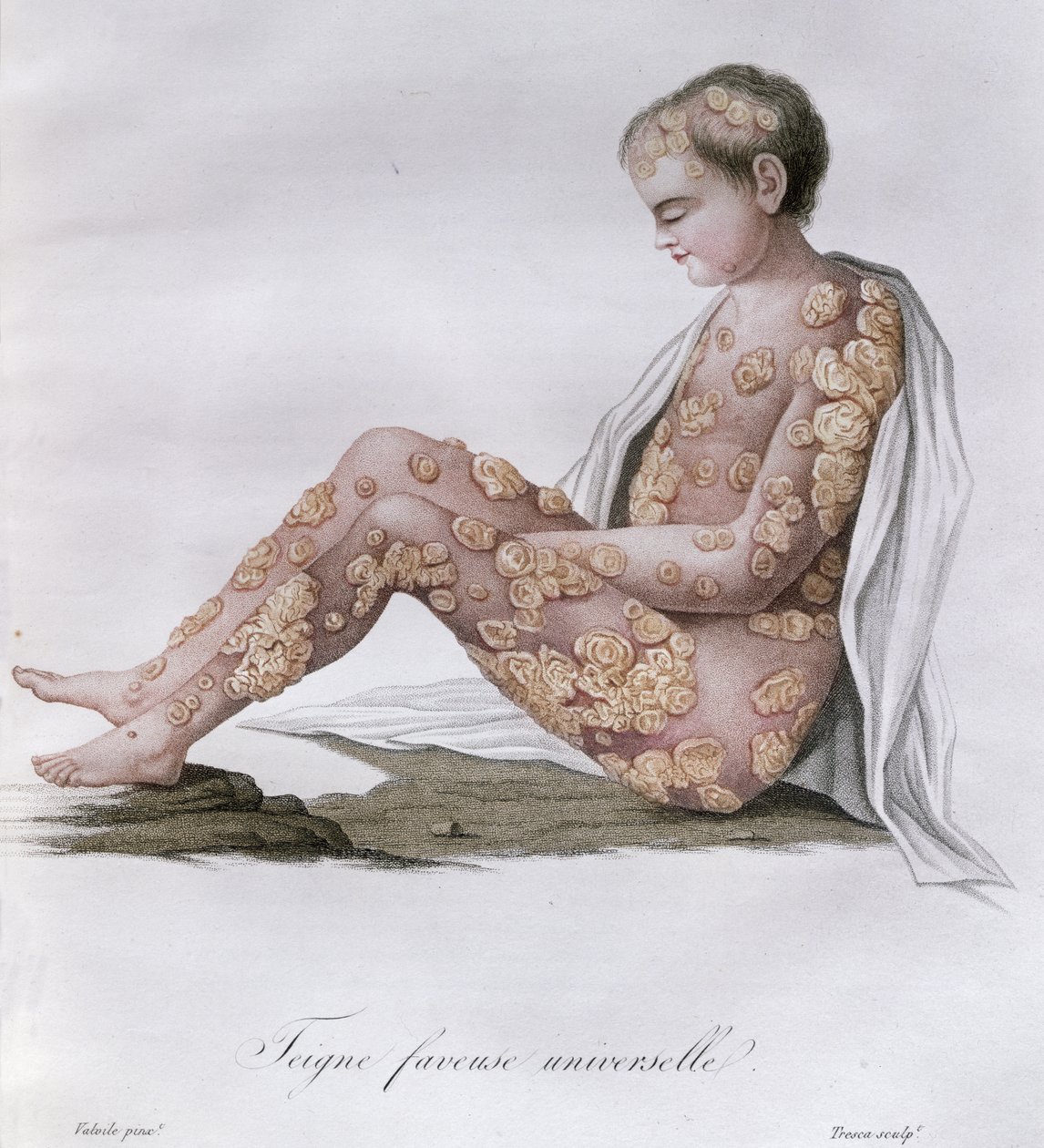 Ringelflechte, aus einem Buch von Baron Jean Louis Alibert (1768-1837) 1838 von French School