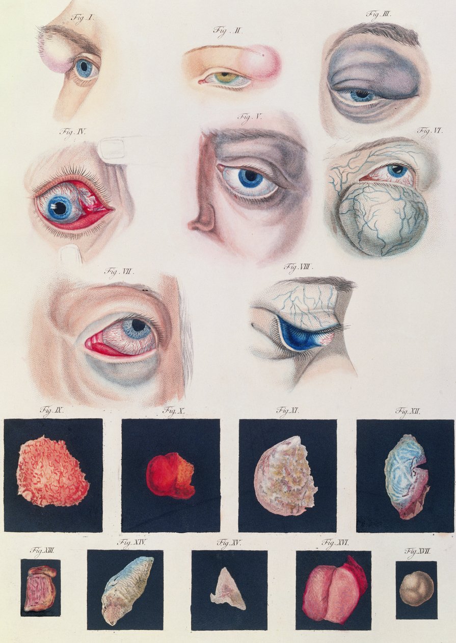 Beschreibung angeborener Augenanomalien, aus Klinische Darstellungen der Krankheiten und Bildungsfehler des menschlichen Auges, von Friedrich August von Ammon (1799-1861) 1838 von German School
