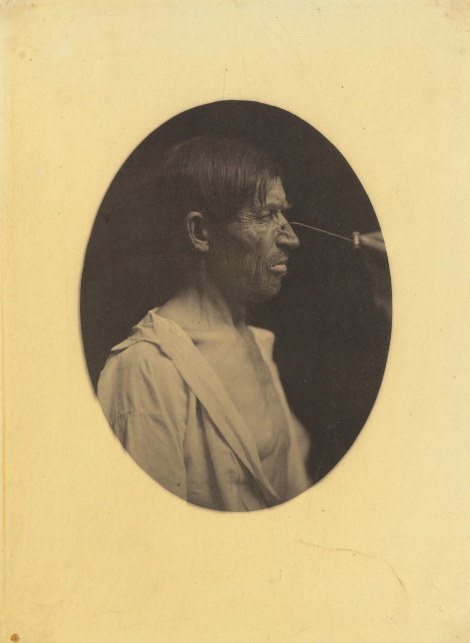 Schlechte Laune, Unzufriedenheit, 1854-1856, gedruckt 1862 (Foto) von Guillaume Benjamin Armand Duchenne de Boulogne