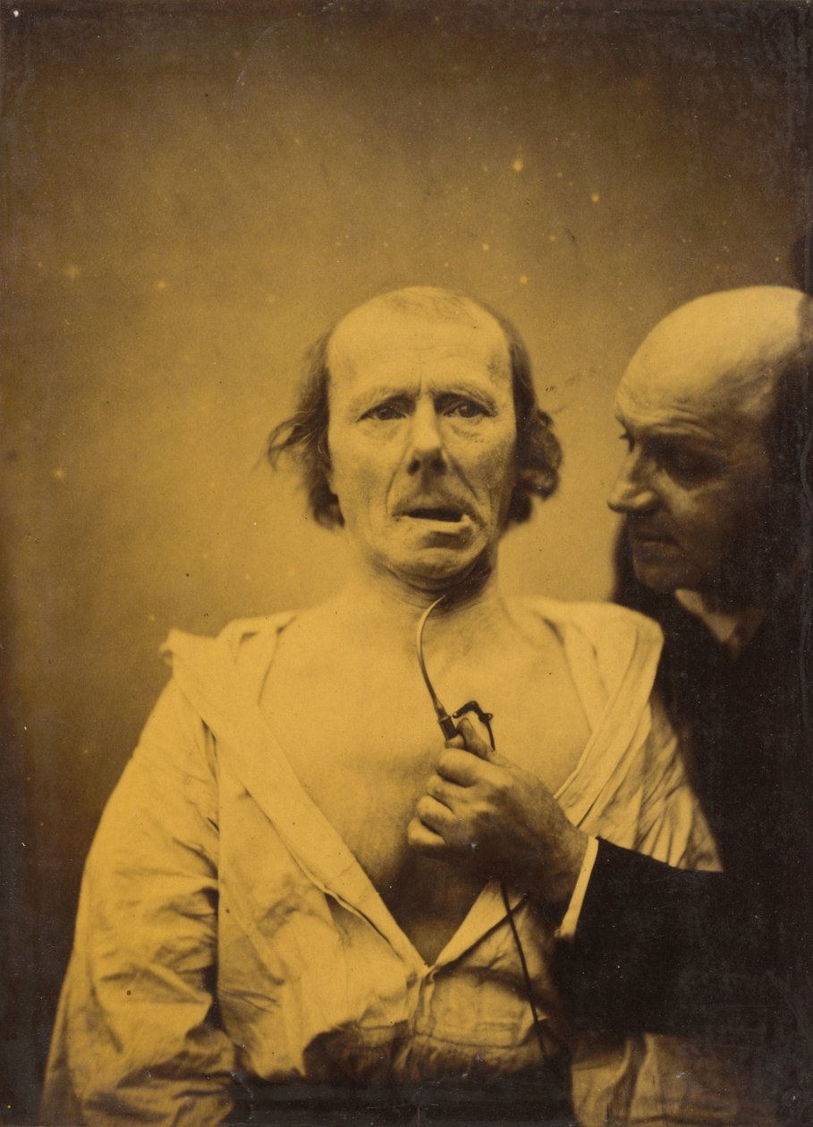 Diese Kontraktion des M. platysma allein fehlt Ausdruck von Guillaume Benjamin Armand Duchenne de Boulogne