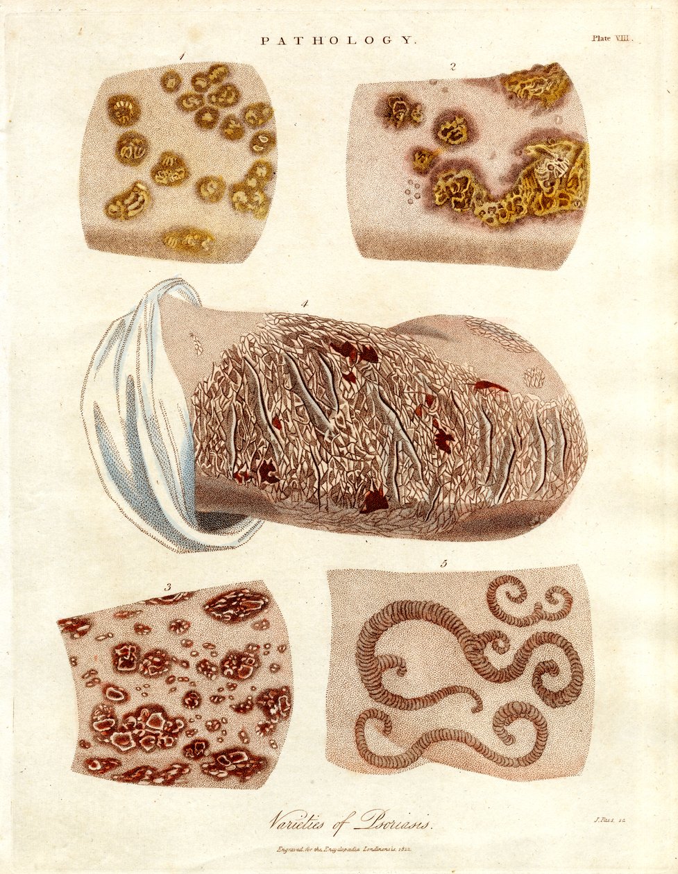 Pathologische Hautveränderungen: Varianten der Psoriasis von John Pass