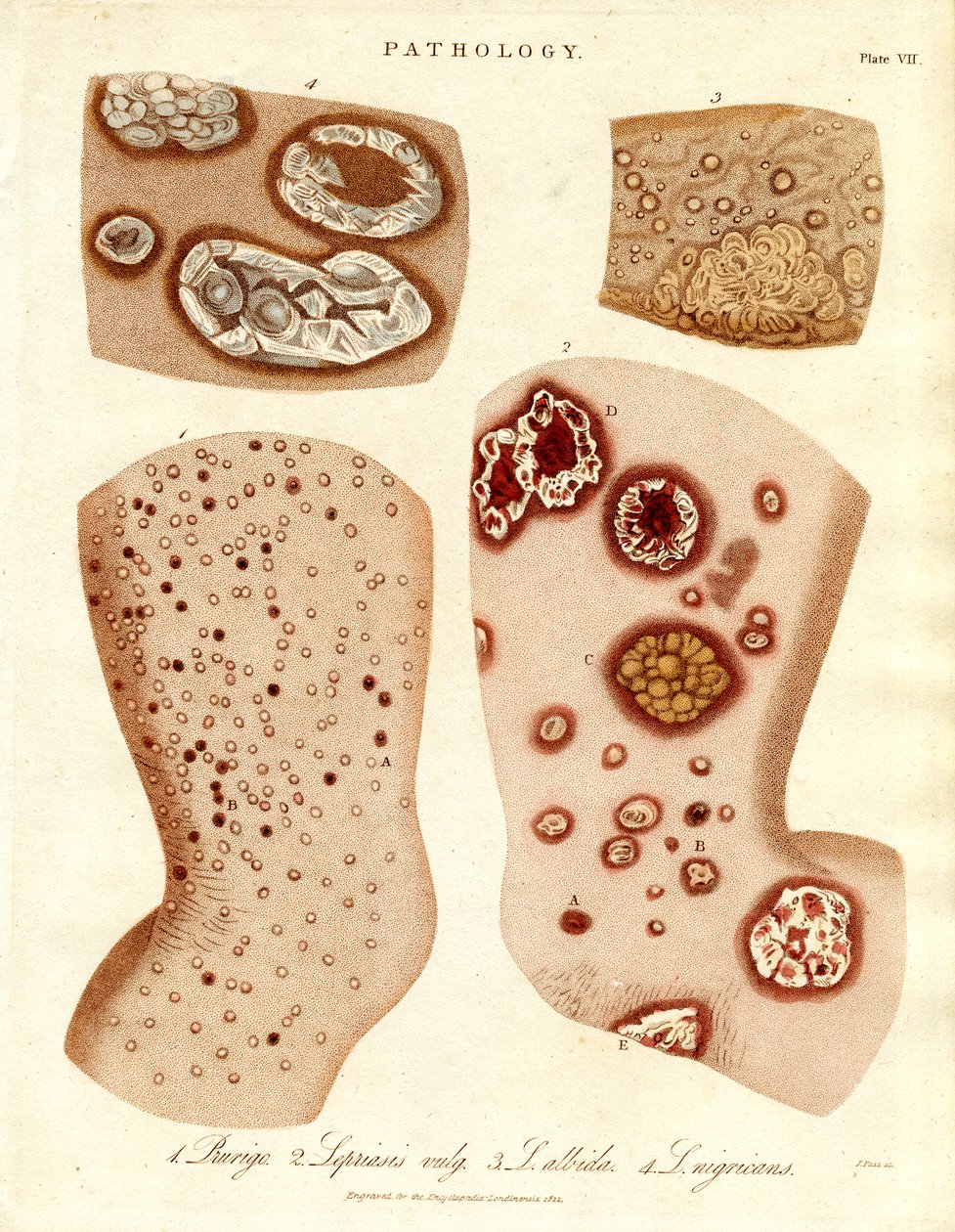 Pathologische Hautzustände: Schurigie; Leprahaut; Pallada und Impetigo von John Pass