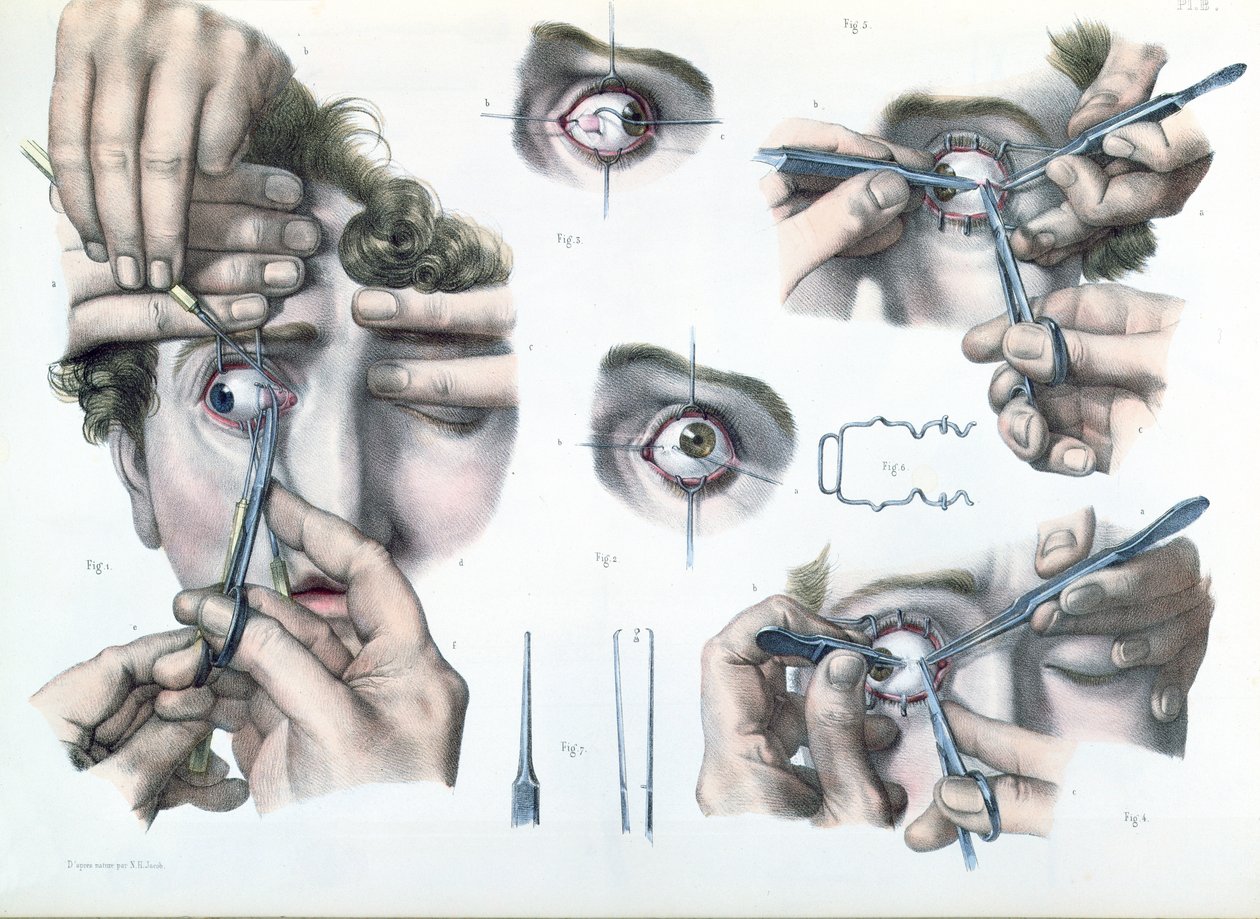 Operation an einem Strabismus, Platte aus 