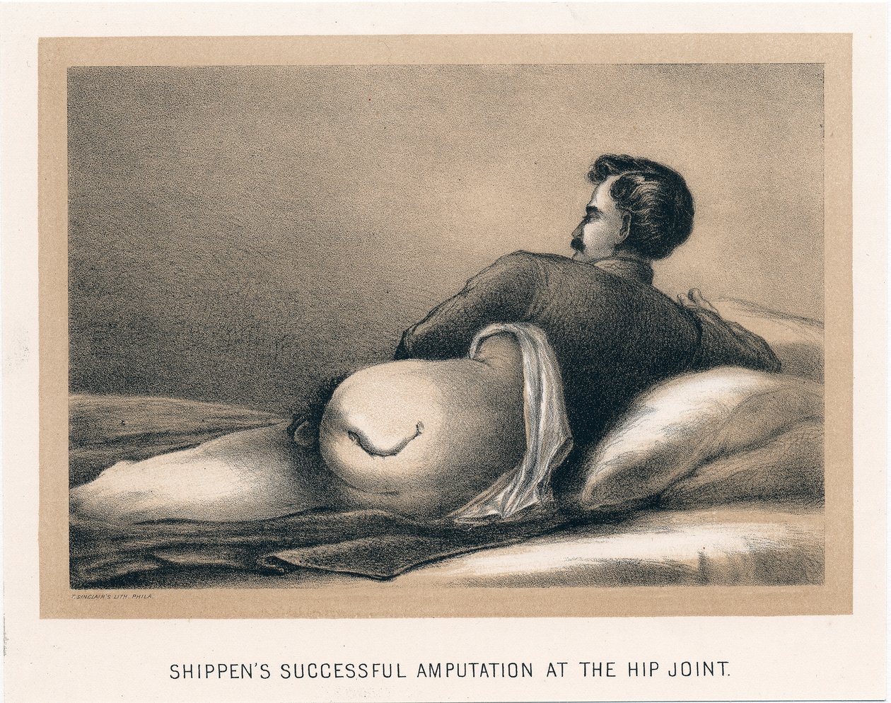 Shippens erfolgreiche Amputation am Hüftgelenk, Amerikanischer Bürgerkrieg, 1865 von Unbekannt