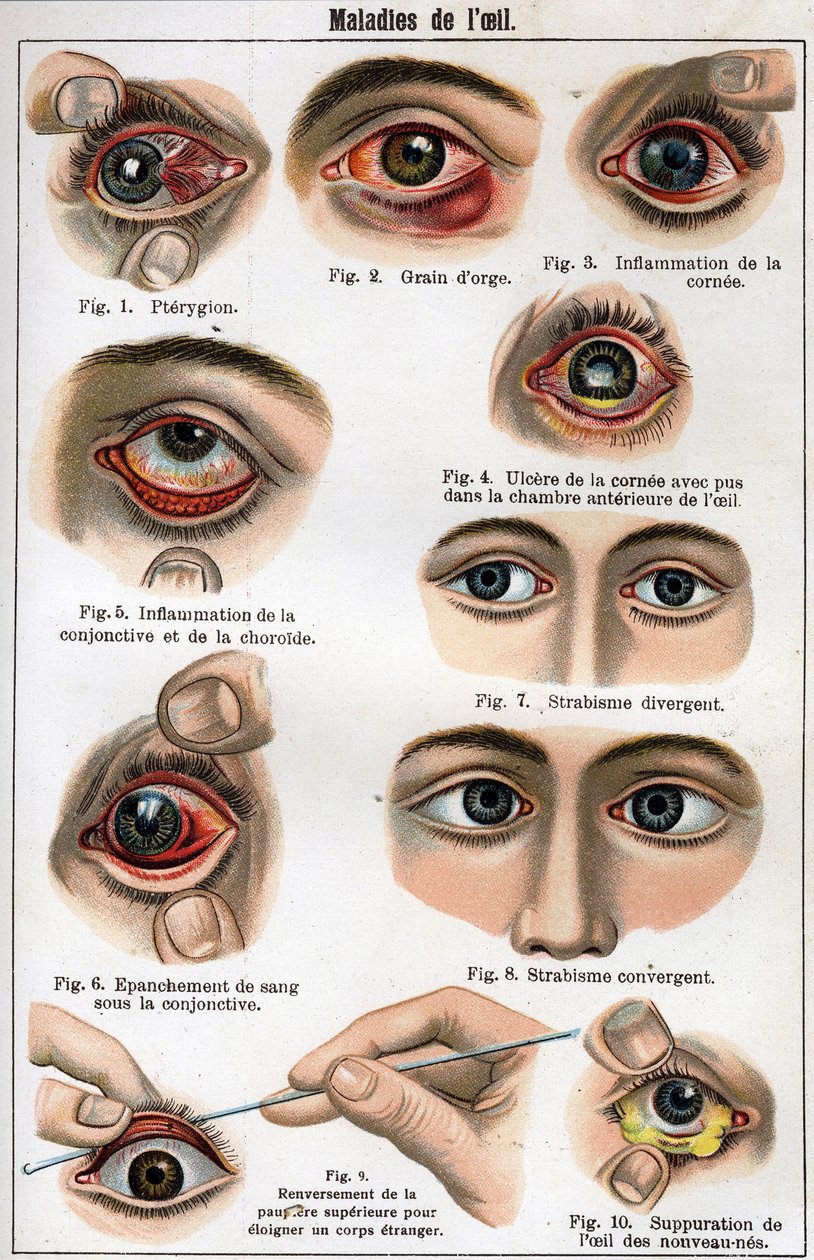 Augenkrankheiten. In „Die neue natürliche Heilung“ von F.E. Bilz. von Unknown artist