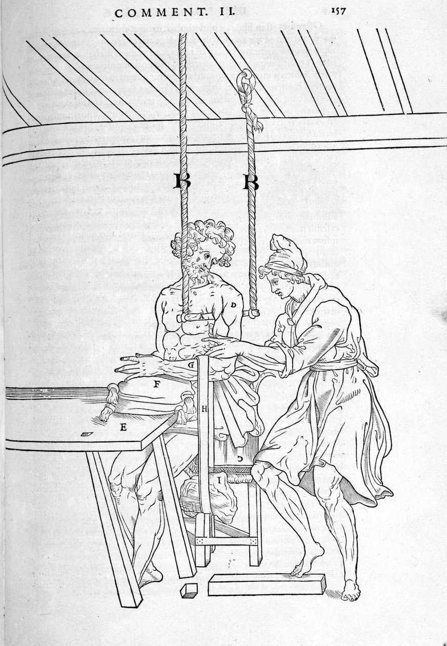Reduktion von Frakturen. Illustrierte Tafel aus „De dissectione partium corporis humani libri tres...“ von Carlo Stefano Riverio, Paris 1545 von Unknown artist