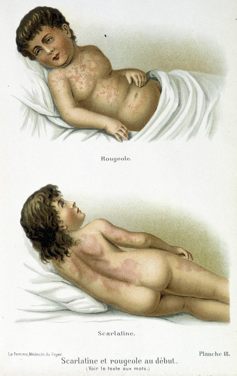 Scharlachfieber und Masern - 19. Jahrhundert von Unknown artist