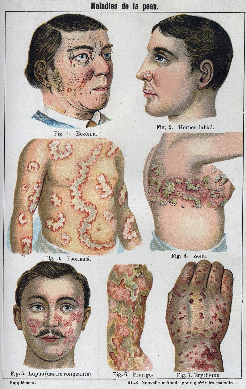 Hautkrankheiten: Ekzeme, Lippenherpes, Psoriasis, Gürtelrose, Lupus, Prurigo, Erythem. In „Die neue natürliche Heilung“ von F.E. Bilz. von Unknown artist