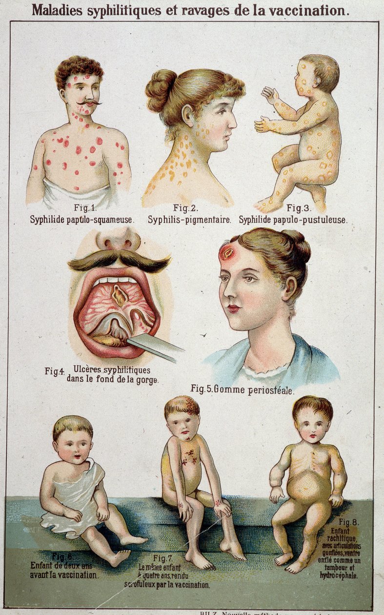 Tafel, die die verschiedenen Formen syphilitischer Krankheiten und die Gefahren der Impfung illustriert - in Bilz Naturheilkunde, Ende des 19. Jahrhunderts von Unknown artist
