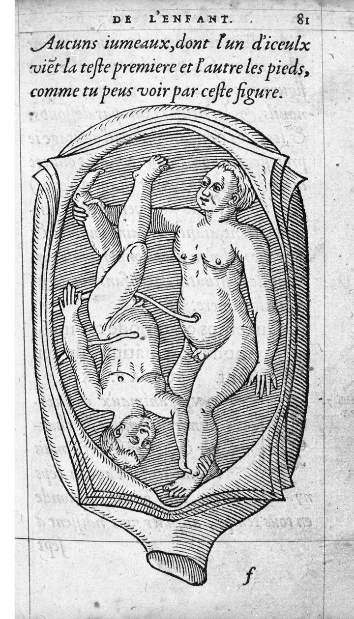 Die Position des Fötus im Uterus während der Schwangerschaft. Gravur aus „De la generation des enfants“ von dem französischen Arzt und Chirurgen Ambroise Paré (1509-1590) 16. Jahrhundert von Unknown artist