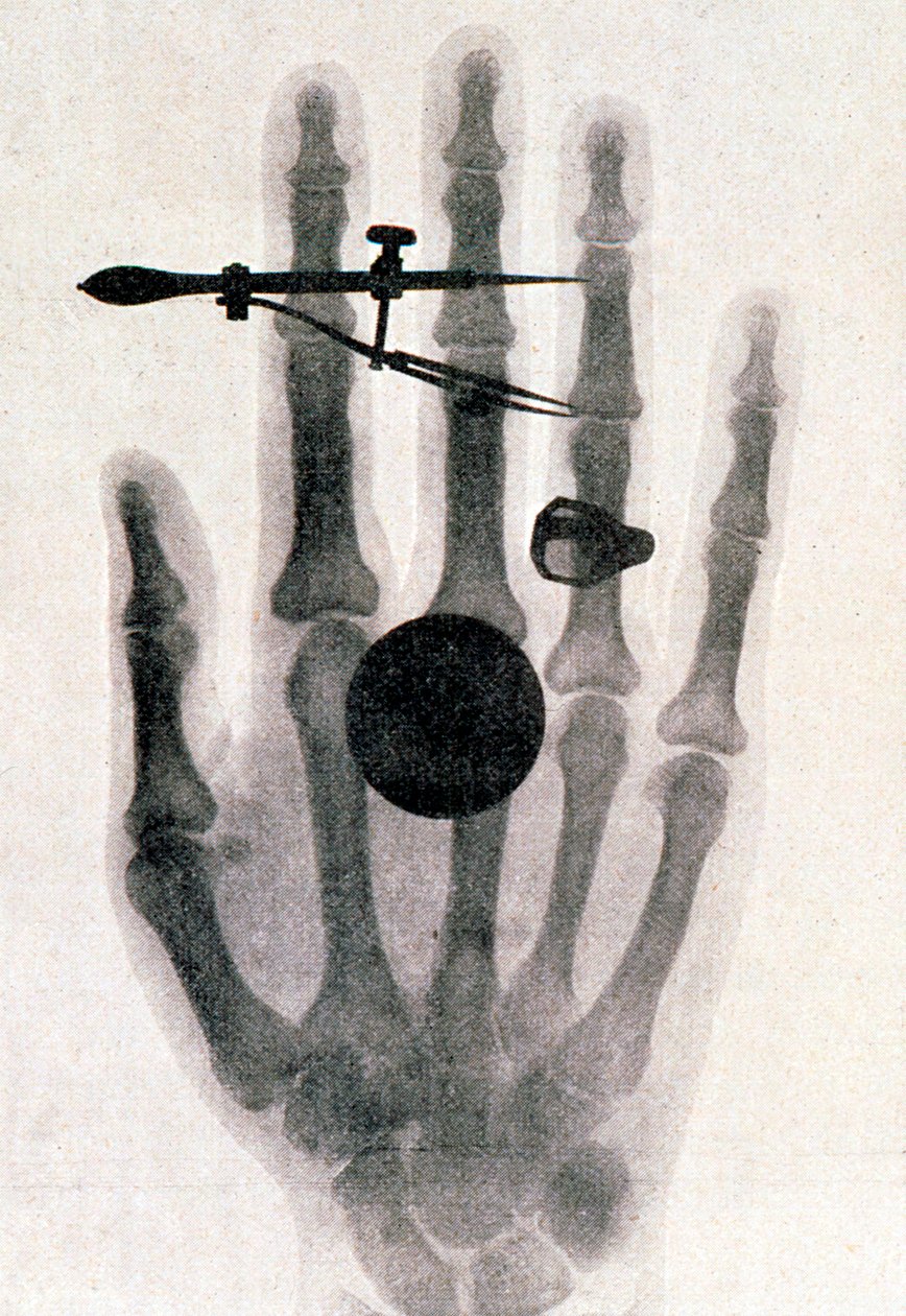 Wilhelm Roentgens Röntgenaufnahme der Hand seiner Frau, 1896 von Wilhelm Conrad Rontgen