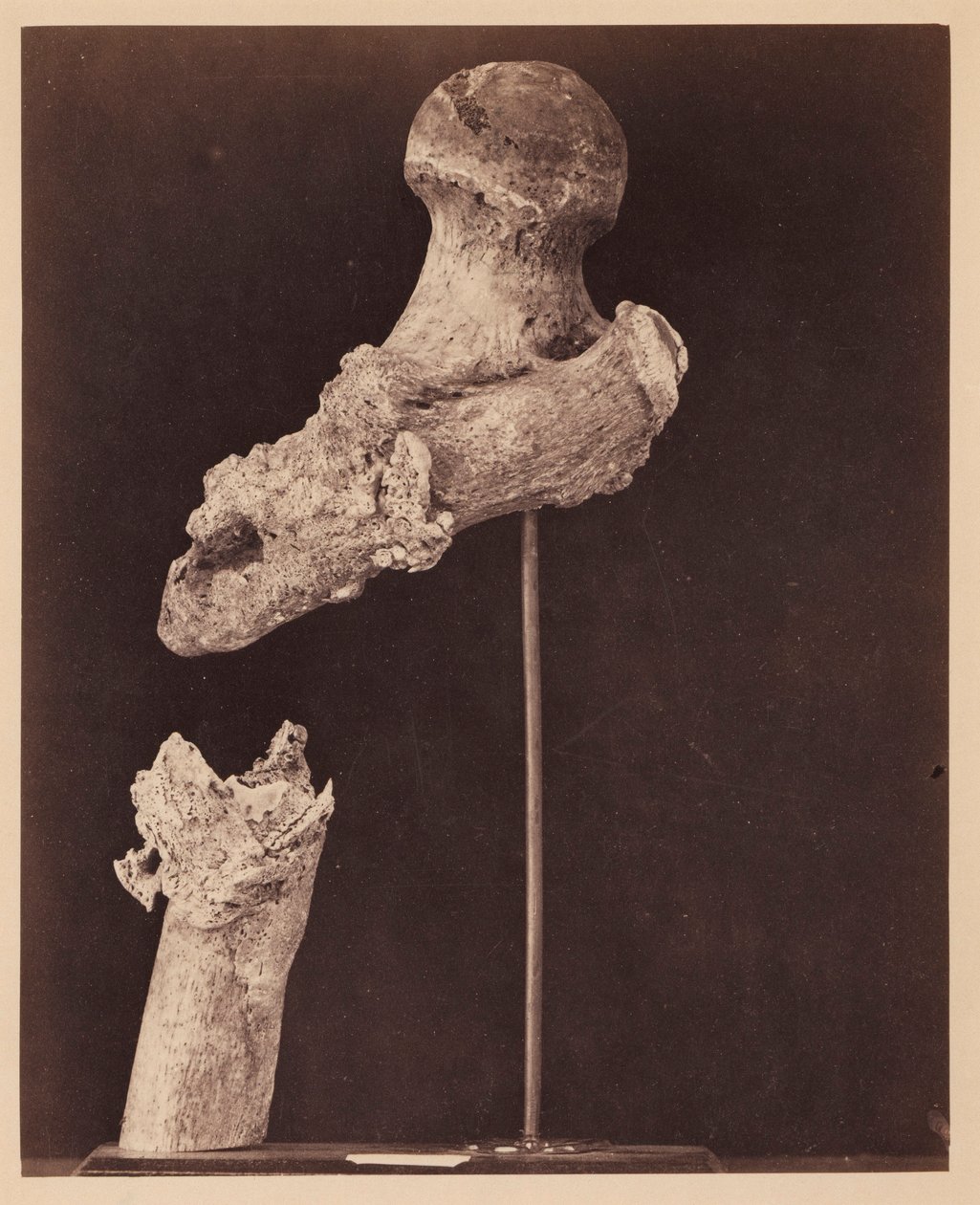 Leutnant Goodwin, verstorben, nicht vereinigte Schussfraktur des oberen Drittels des rechten Oberschenkels, sieben Monate nach der Verletzung, aus dem fotografischen Katalog der chirurgischen Abteilung von William Bell