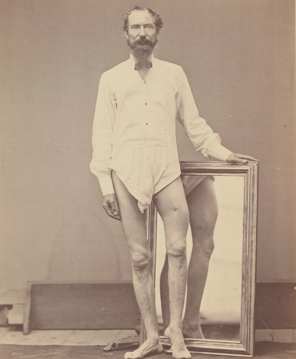 Schusswunde des mittleren Drittels des linken Oberschenkels von William H. Bell