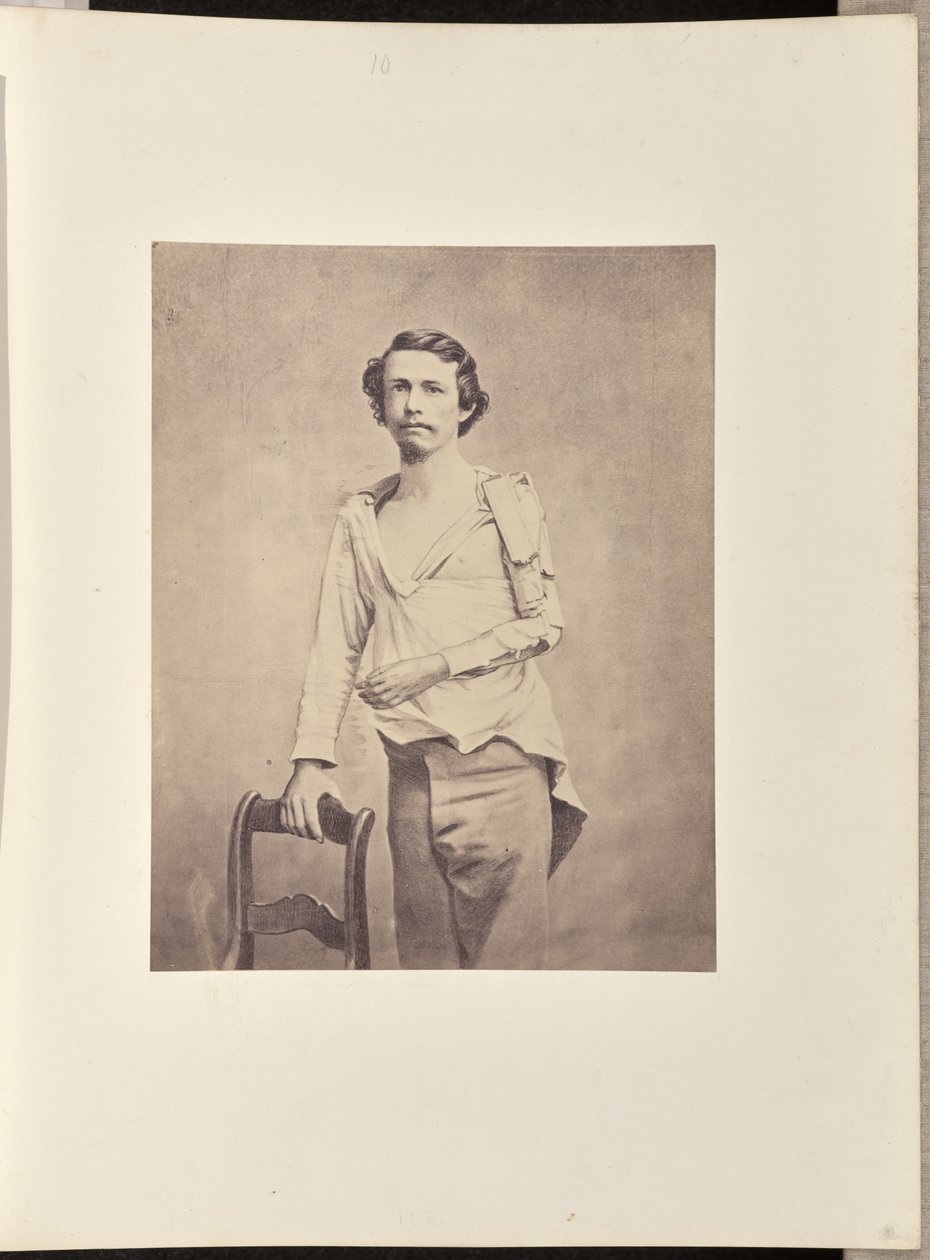 Erfolgreiche Exzision des Kopfes des linken Humerus, gefolgt von Nekrose und sekundärer Exzision des restlichen Humerus und der oberen Extremitäten des Radius und der Ulna von William H. Bell