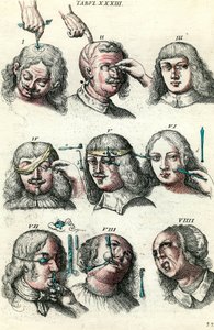 Chirurgie im 18. Jahrhundert: Trepanation und Operation von Auge und Gesicht. Gravur in „Institutionis chirurgicae“ von Lorenzo Heister
