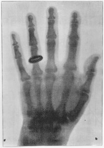 Röntgenaufnahme der linken Hand von Anna Bertha Ludwig, Röntgens Frau