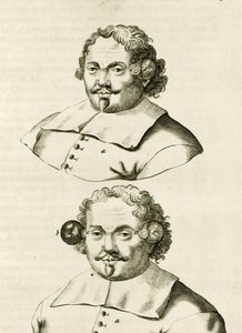 Ein Beispiel für Schröpfen, aus Exercitationes Practicae circa Medendi Methodum von Frederik Dekkers, 1694