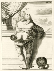 Ein Beispiel für Schröpfen, aus Exercitationes Practicae circa Medendi Methodum von Frederik Dekkers, 1694