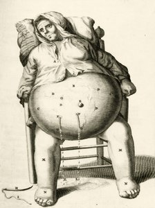 Abfluss von Flüssigkeit aus einem Abszess, aus Exercitationes Practicae circa Medendi Methodum von Frederik Dekkers, 1694