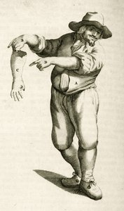 Entfernung abgestorbener Haut mit Pusteln, aus Exercitationes Practicae circa Medendi Methodum von Frederik Dekkers, 1694 von Dutch School