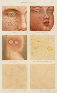 Eruptive Fieber