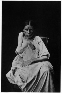 Fotografie eines Patienten mit hemiplegischer Epilepsie, in „photographische Ikonographie der Salpêtrière“, Bourneville und P. Regnard, Paris