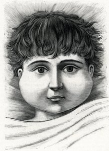 Kind mit Mumps (Gravur) 1888