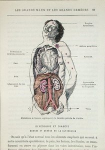 Auswirkungen von Diabetes, aus 