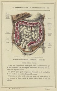 Entzündung des Dickdarms, Charakteristische Läsionen der Dysenterie von French School