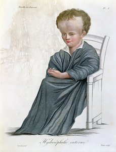 Interner Hydrozephalus, aus Nosologie Naturelle von Baron Jean Louis Alibert (1768-1837) graviert von Tresca, 1817 von French School