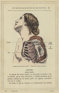 Luxation unter dem Rabenschnabelfortsatz der Schulter, Verlagerung des Humeruskopfes von French School