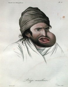Maxillärer Polyp, aus einem Buch von Baron Jean Louis Alibert 1817