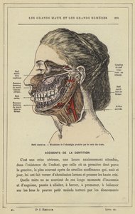 Zahnnerven, Mechanismus der Zahnschmerzen durch Karies von French School
