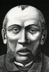 Patient mit Gehirnerweichung (Gravur) 1888