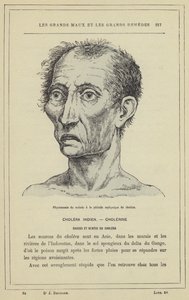 Gesichtsausdruck eines Kranken in der asphyktischen Phase der Cholera von French School