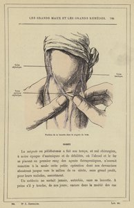 Position der Lanzette beim Aderlass am Arm von French School