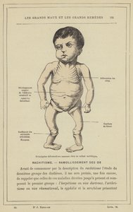 Hauptsächliche Knochendeformationen bei einem rachitischen Kind