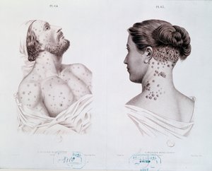 Symptome der Syphilis bei Männern und Frauen, aus einem medizinischen Buch, ca. 1850-60