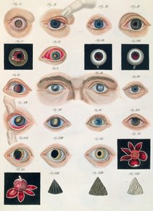 Beschreibung angeborener Augenanomalien, aus Klinische Darstellungen der Krankheiten und Bildungsfehler des menschlichen Auges, von Friedrich August von Ammon (1799-1861) 1838