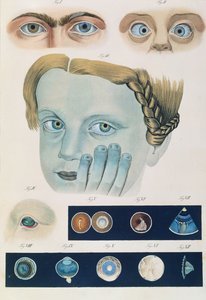 Beschreibung angeborener Augenanomalien, aus Klinische Darstellungen der Krankheiten und Bildungsfehler des menschlichen Auges, von Friedrich August von Ammon (1799-1861) 1838 von German School