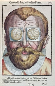Behandlung einer Augenkrankheit, aus Ophthalmodouleia von Georg Bartisch (1535-1636) veröffentlicht in Dresden 1583 (Farbholzschnitt)