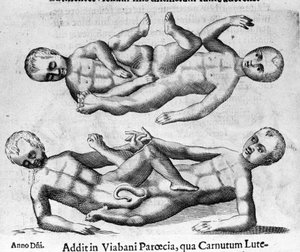 Verschiedene Arten menschlicher Monster: siamesische Kinder, die durch das Becken verbunden sind. Stich aus „De monstrorum natura, causis et differentiis“ von Fortunio Liceti (1577-1656), italienischer Wissenschaftler. 1646