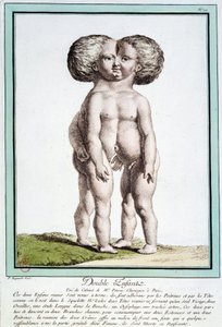 Siamesische Kinder - in „Les deviations de la nature“ von Régnault