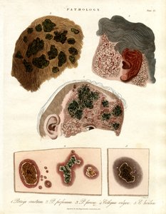 Pathologische Hautveränderungen: Porriga und Ecthyma