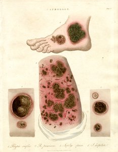 Pathologische Hautzustände - Pityria; Impetigo und Syphilis